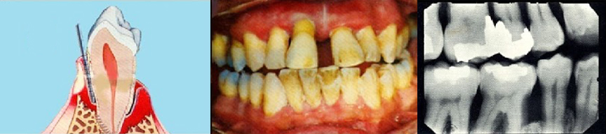 Advanced Periodontitis Old Hook Dental