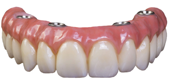 All on four prosthesis, full mouth bridge, full teeth replacement, implants and bridge, tooth replacement