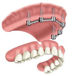 Bar implant denture, hader bar, teeth on implants, implant denture, bar denture, removable denture, overdenture