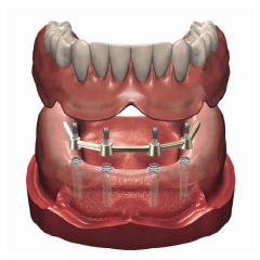 Bar supported overdenture Old Hook Dental