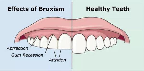 Bruxism, teeth grinding, clenching, stress grinding, stop clenching, grinding protection