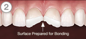 Veneer bonding, Dental Bonding, Chipped tooth, cracked tooth, cosmetic repair