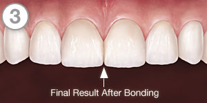 Bonding, tooth bonding, veneer, dental repair, chip repair, composite bonding