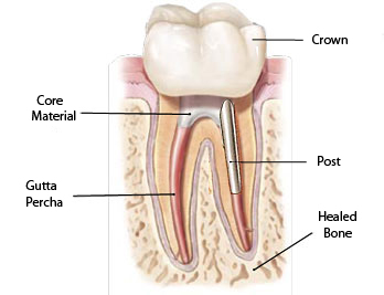 Root Canal Completed, Dental Crown, Dental Infection Old Hook Dental
