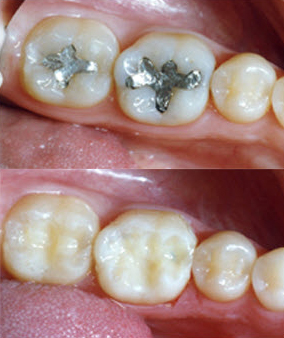 Tooth colored filling, composite filling, white filling, silver, amalgam