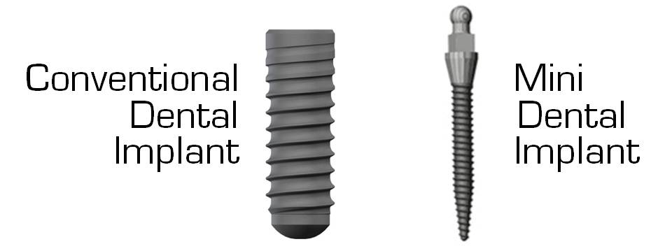 Implant vs mini implant, implant difference, mini implant, dental implant, old hook dental, dentist