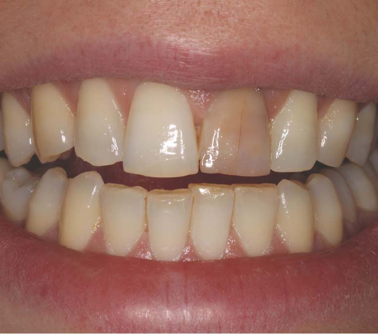 Discolored Tooth, Dark Tooth, Darkened Tooth, Root Canal, Dental Crown