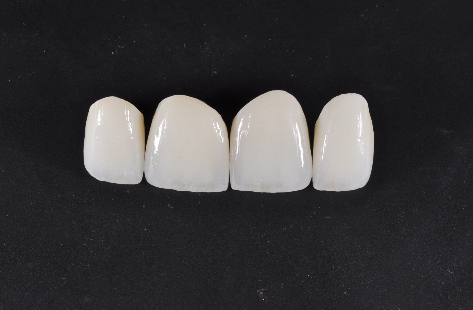 Dental full porclain crowns, all porcelain, all ceramic, white teeth replacement, ceramic teeth,  