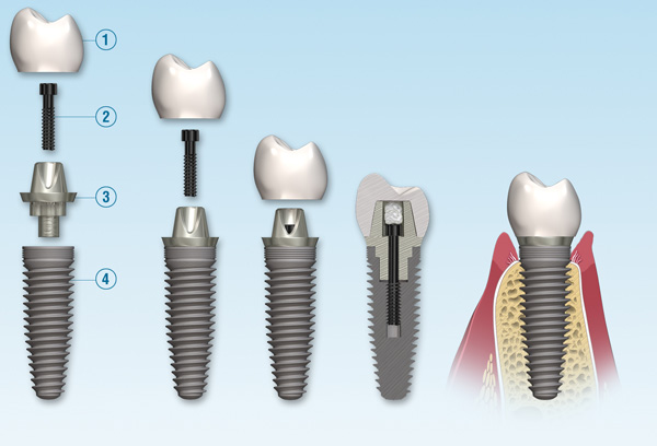 Dental implant parts, implant tooth replacement, teeth replacement, dental implant, westwood dental