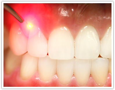 painless Dental, laser treatment, laser dentistry, painless dentistry, no bleeding dental cutting, blameless dentistry, laser technology 