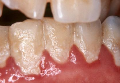 Dental Plaque, tartar, Dental cleaning