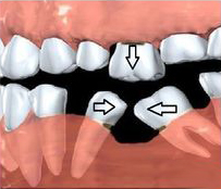 tooth collapse, tooth drift, dentist, missing tooth, replace tooth, broken tooth, implant, bridge