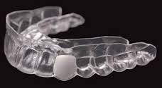 Essix retainer, immediate tooth replacement, removable tooth replacement, clear tooth replacement