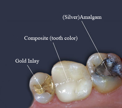 Dental Fillings