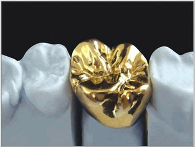 gold crown, full gold crown, gold tooth, metal tooth, gold teeth, all gold tooth