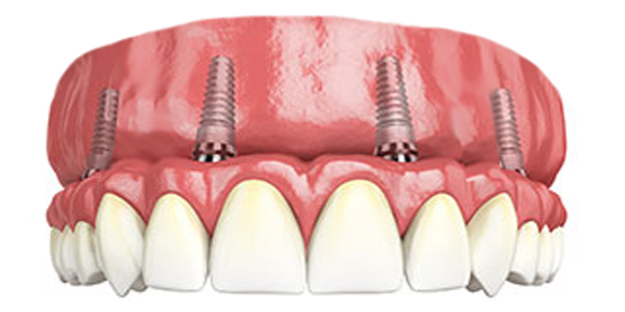 Full upper implant supported teeth all on four, all on 4, full mouth replacement, teeth replacement, fixed denture, implant bridge