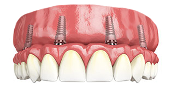 Full upper implant supported teeth all on four, all on 4, full mouth replacement, teeth replacement, fixed denture, implant bridge