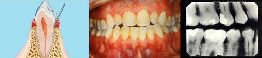 Gingivitis Old Hook Dental