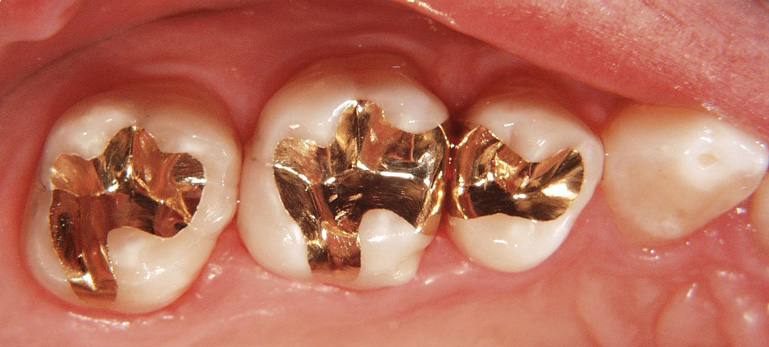 Gold filling, tooth colored filling, dentist, Cavity, Sensitivity, dental restoration