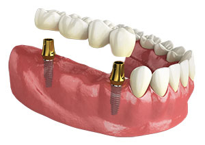 Implant bridge, multiple teeth replacement, teeth on implants, bridge with implants, screw retained teeth, bridge