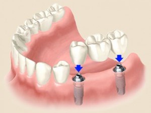Implant bridge, implant crown, implant cap, missing teeth, new teeth