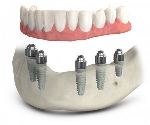Implant denture, new teeth, full mouth tooth replacement, dentures with implant, supported denture