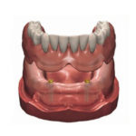 Implant supported overdenture, edentulous teeth replacement, full teeth replacement, denture on implants