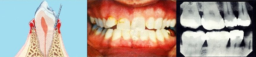 Periodontitis Old Hook Dental