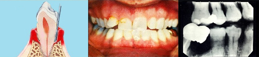 Moderate Periodontitis Old Hook Dental
