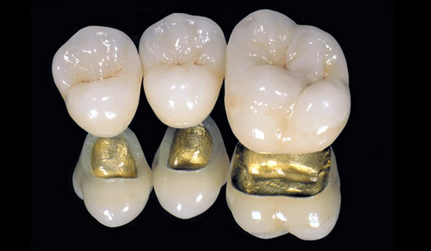 porcelain gold tooth, gold tooth, white gold tooth, gold bridge, gold tooth replacement, best restoration, best dental bridge