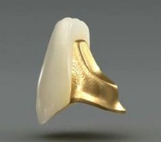 porcelain and gold veneer, veneer tooth, cosmetic tooth, gold tooth, porcelain tooth, white and gold tooth replacement
