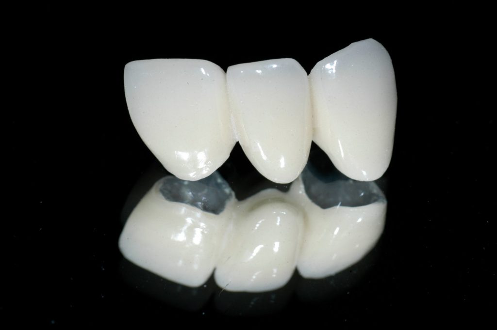 porcelain metal crown, porcelain metal bridge, dental bridge, dental tooth replacement, white bridge, white teeth, new teeth, missing tooth