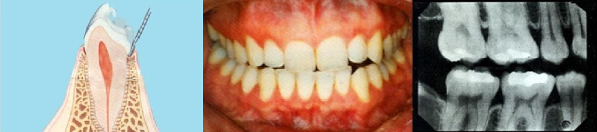 Gum disease, periodontal disease, periodontitis, gingivitis, dental cleaning, Old Hook Dental, Dr. Philip Aurbach