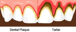 Dental Plaque Tartar, Cleaning Westwood NJ 07675