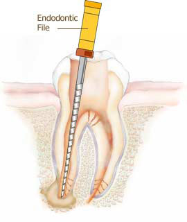 Root Canal, Old Hook Dental Infected tooth