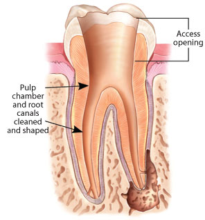Root Canal Procedure, Old Hook Dental Cavity, Tooth Pain
