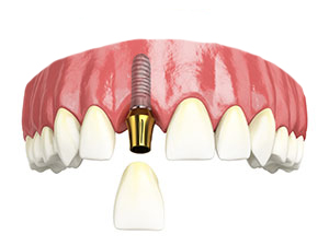 Single tooth implant, tooth replacement, what is a dental implant, missing tooth