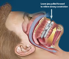 Sleep apnea guard, snore guard, breathing guard, night time airway, sleeping and snoring