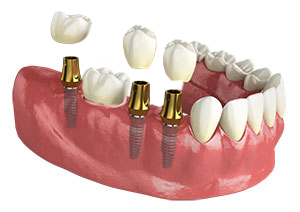 multiple dental implants, multiple tooth replacement, dental implant and crown, dental crowns with implants, multiple teeth replacement