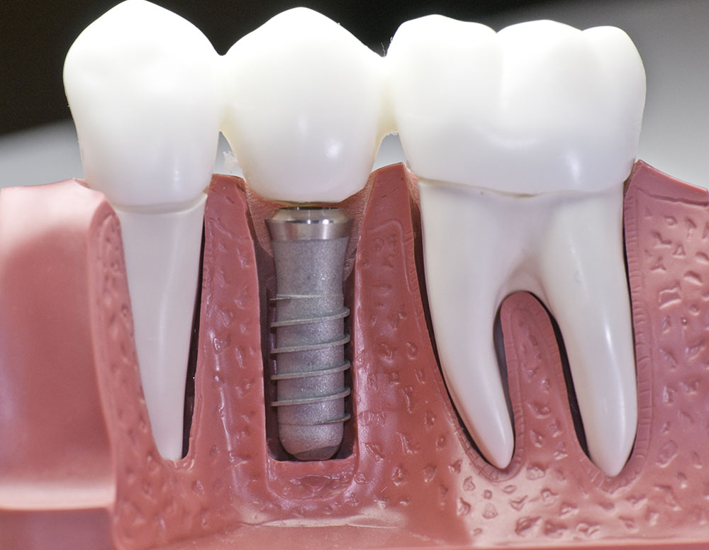 Tooth to implant bridge, teeth replacement option, implant tooth, new tooth, dental implant