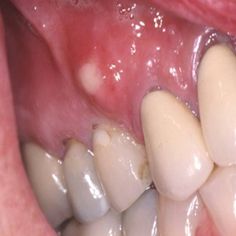 Dental abscess, Dental Pain, Puss, Root Canal, tooth pain, Swelling, endodontist, swollen tooth, Dentist, Old Hook Dental, Dr. Philip Aurbach