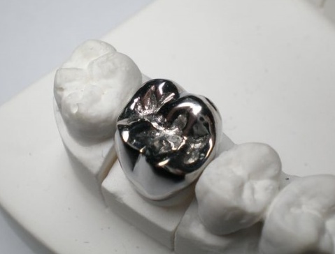 Silver tooth, base tooth, base crown, silver crown, gold crown, metal crown, metal tooth, dentist 