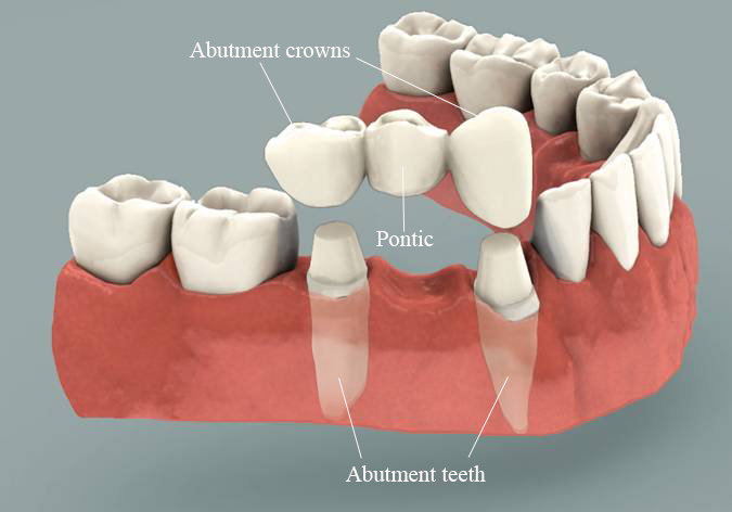 Dental bridge, porcelain bridge, tooth colored bridge, missing tooth, tooth replacement