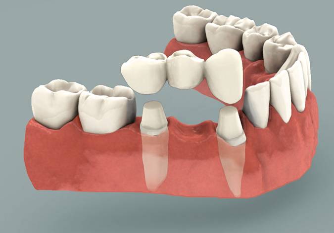 porcelain bridge, dental bridge, dental implant, bridge, teeth, replacement tooth, broken tooth