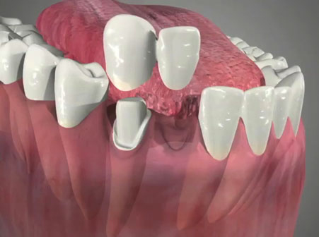 cantilever bridge, porcelain bridge, crown bridge, tooth replacement, missing tooth, denture