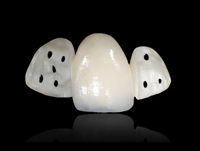 composite bridge, maryland bridge, tooth colored bridge, immediate tooth replacement, single tooth replacement