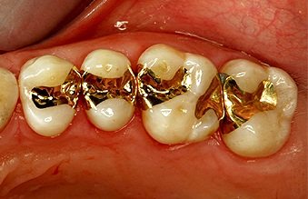 gold inlay, gold onlay, cavity filling, tooth filling, gold tooth