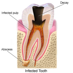 infected tooth, Cavity, Dental Decay, Dental Infection
