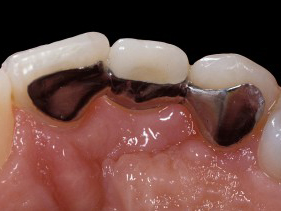 metal maryland bridge, composite tooth bridge, tooth colored bridge, single tooth replacement