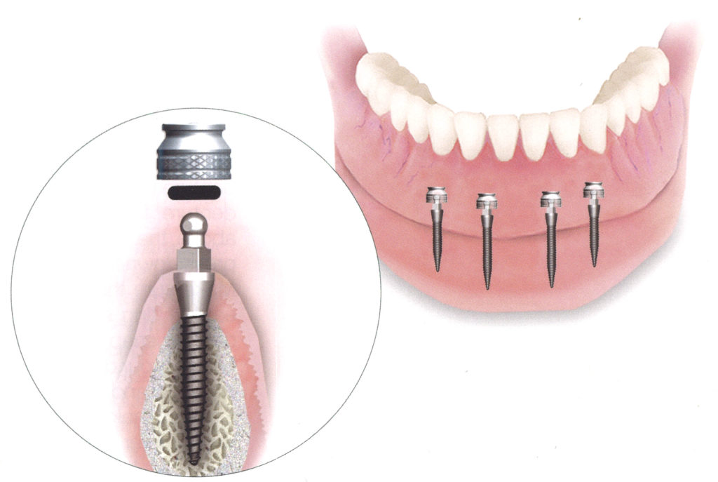 mini implants, mini implant denture, mini teeth replacement, immediate implant and denture